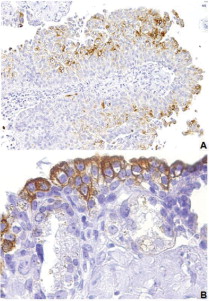 p-mTOR immunoexpression in normal and malignant urothelium. A, non-muscle ...