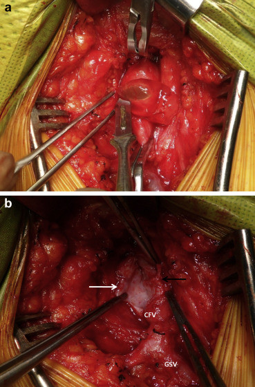 (a) Operative image illustrating the gushing of gelatinous mucoid content from ...