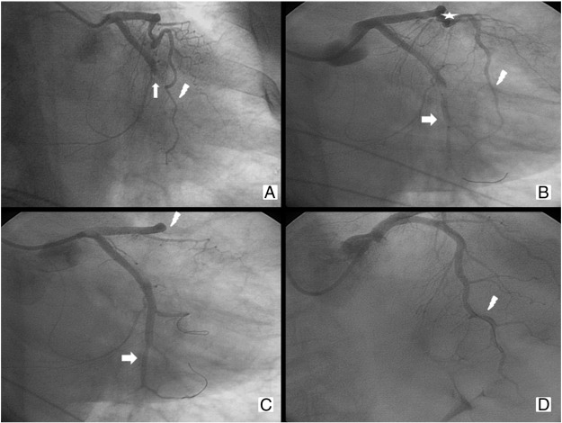 The angiogram shows acute occlusion of the proximal part of circumflex artery ...