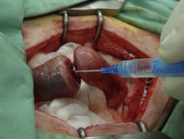 Application of the cyanoacrylate glue on the two sections of the colon being ...