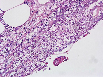 Yeast-like fungi are noted at the serosal side of the intestine.