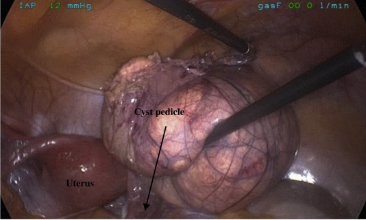 Intraoperative view showing normal uterus. A pedicled mesenteric cyst that ...