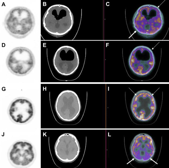 (A, D) PET, (B, E) CT, and fused (C, F) PET/CT images obtained at the mutistic ...