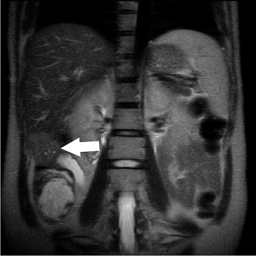Magnetic resonance imaging showed a 42-mm hepatic mass in the inferior part of ...