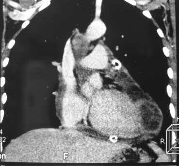 Computed tomography scan revealing multilocular well-bordered cystic mass with ...