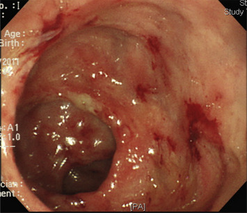 Colonoscopy image showing diffuse inflammatory mucosa associated with multiple ...