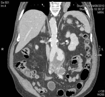 Late intervention Patient 2.