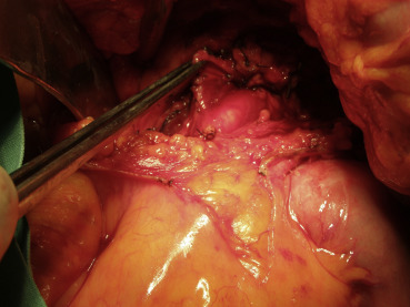 Surgical exploration of the tumor and the demonstration of the superior ...