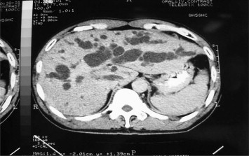 Computed tomography scan of the liver showed marked dilated bilateral ...