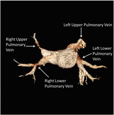3D Reconstruction of pulmonary veins showing stenosis of RUPV and RLPV as well ...