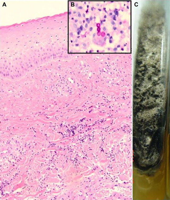(A) There were marked neutrophilic infiltrates primarily in the reticular dermis ...