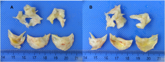 Macroscopic appearance of the surgical specimens, with the two fragments of ...