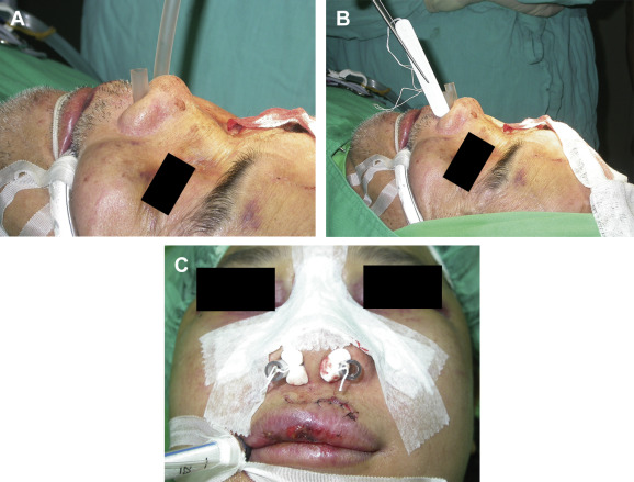(A, B) After closed reduction, a silicone catheter with multiple side holes was ...