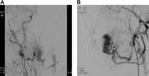 (A) Right external-carotid angiogram, anteroposterior (AP) view and (B) left ...