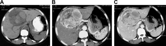 CT image of hepatic PEComa. (A) Plain CT scan showed a well-demarcated mass with ...