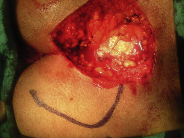 Excision of sinüs and marking of flap.