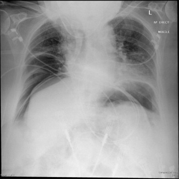 Mobile erect chest X-ray demonstrating free gas.