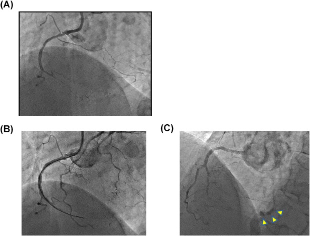 (A) Chronic total occlusion (CTO) of the mid-right coronary artery (RCA) ...