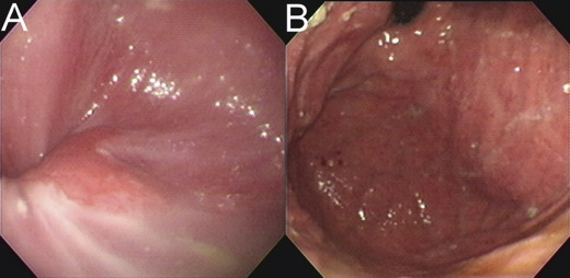 Initial esophagogastroduodenoscopy. (A) Erosive esophagitis is identified in the ...