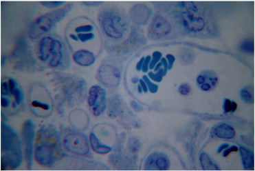 Tumour cells in inguinal lymph node structure 25days after termination of ...