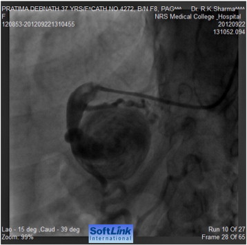 Selective angiography of feeding vessel to aneurysm via a right Judlins ...