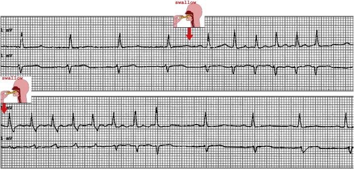 Telemetry showing atrial fibrillation every time the patient swallows food.