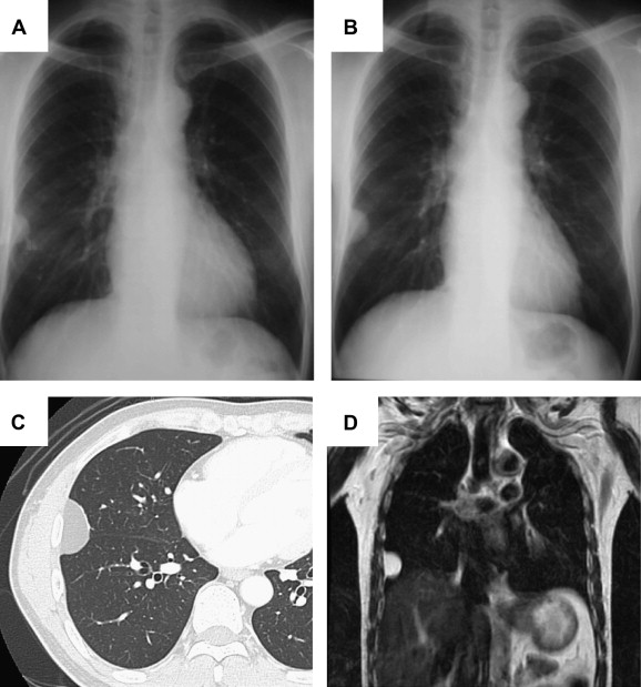 The chest X-ray shows a tumor shadow in the right middle lung field. (A) A ...