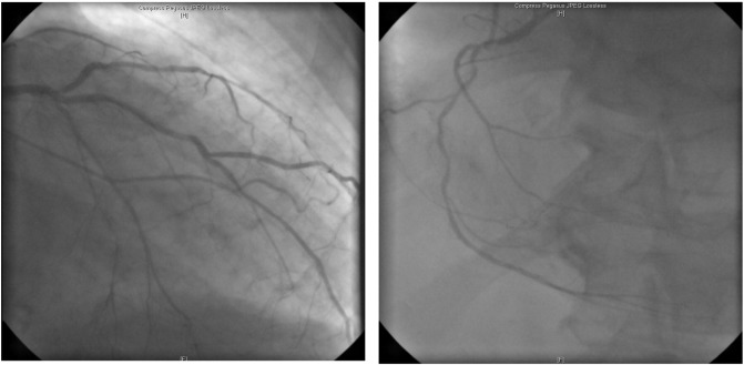 Coronary angiogram shows a three-vessel coronary artery disease. (A) Left ...