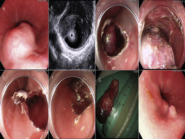 (A) Huge submucosal tumor is noted at a distal segment of the esophagus, close ...