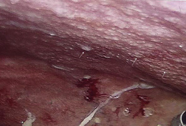 Laparoscopy. Diffuse white nodules (arrow) are found in the peritoneum.