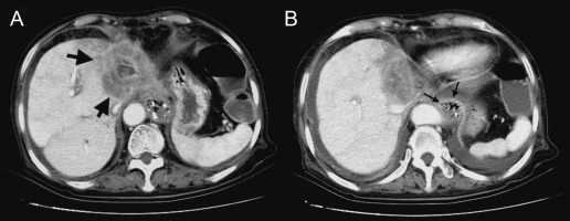 Abdominal computed tomography. (A) A hypodense tumor located in the left lobe of ...