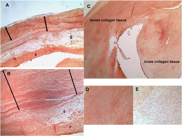 Major fibrous thickening of the endocardium (arrows) on the ventricular aspect ...