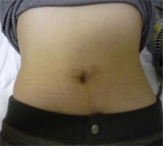 Postoperative appearance of patients abdomen after needle-assisted ...