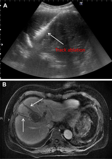 (A) Track ablation under 40 W energy output to form “Comet tail” appearance. (B) ...