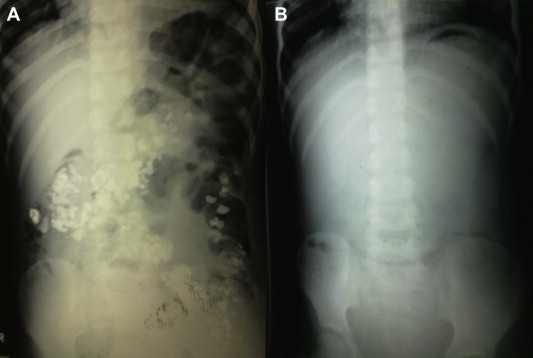 (A) Erect X-ray of the abdomen showing gravel inside the large and small bowel; ...