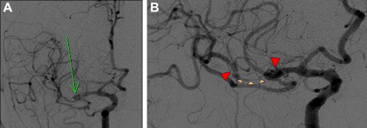 Representative cerebral angiograms on the day of aneurysm onset. (A) ...