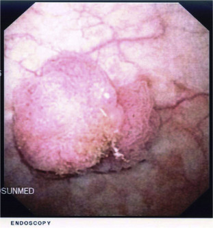 Cystoscopic view of bladder lesion.