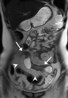 A 40-year-old woman. Coronal T2-HASTE image shows skipped disease-involved ileal ...