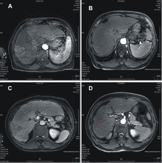 Effect of treatment with sorafenib and radiotherapy evaluated by abdominal ...