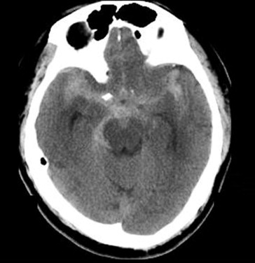 Computer tomography scan of a diffuse subarachnoid hemorrhage over the basal ...
