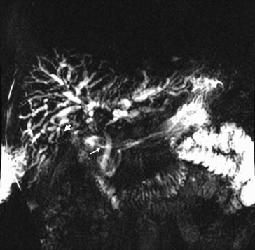 Multifocal stricture and beading throughout the extra- and intrahepatic ducts ...