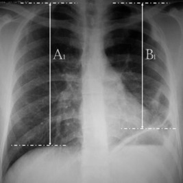 Postoperative chest X-ray.