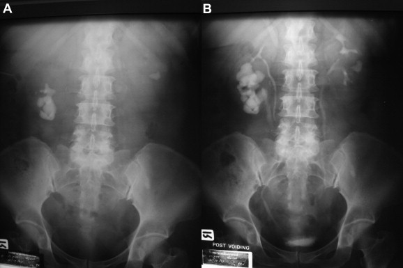 (A) Double collecting system of right kidney with staghorn calculi in lower ...