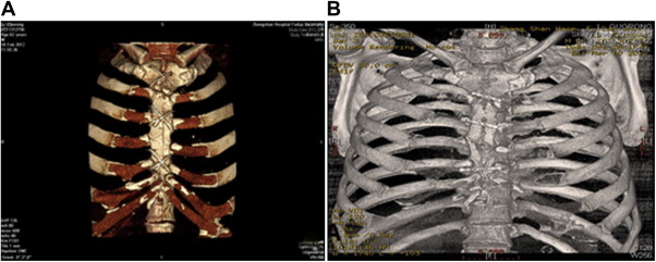 Man (65 years old) with sternum infection 1 month after the pericardial ...