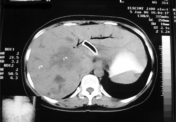 Follow-up computed tomography scan showed metallic stent drained at the ...