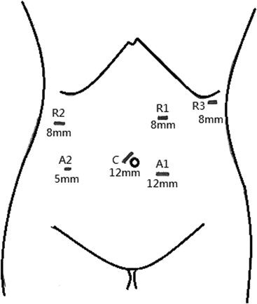 Port size and positions. A1, A2 = assistant ports for bedside surgeon; ...