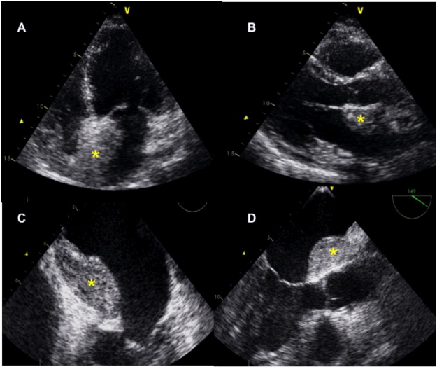 Panels A and B. TTE image showing the presence of atrial hematoma in interatrial ...