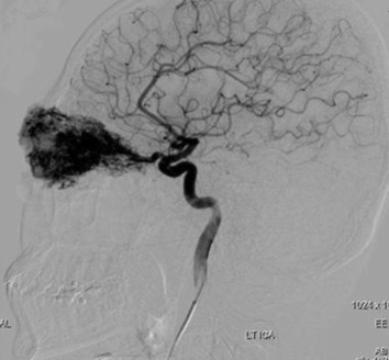 Internal carotid artery run showing arteriovenous malformation feeder vessels ...