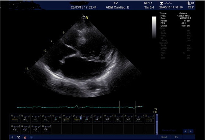 Transthoracic, two-dimensional echocardiographic image demonstrating prolapse of ...