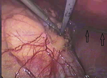 Intraoperative view of pure needlescopic-instrument clipless right adrenalectomy ...